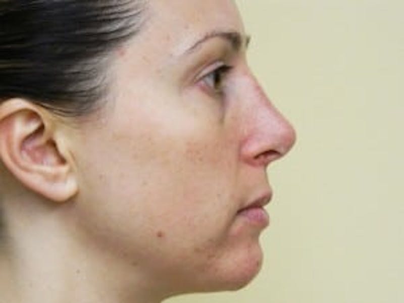 Revision Rhinoplasty Before & After Gallery - Patient 133066545 - Image 4