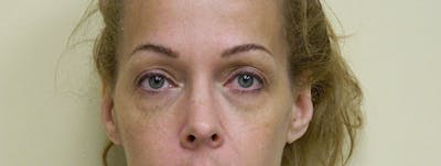 Blepharoplasty (Eyelid Lift) Before & After Gallery - Patient 133066547 - Image 1