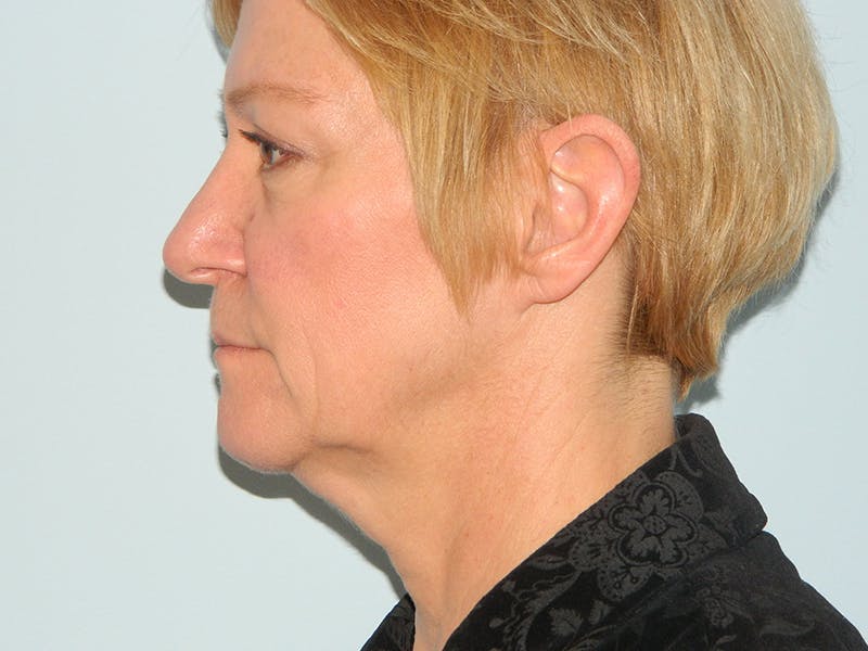 Facelift Before & After Gallery - Patient 133066551 - Image 1