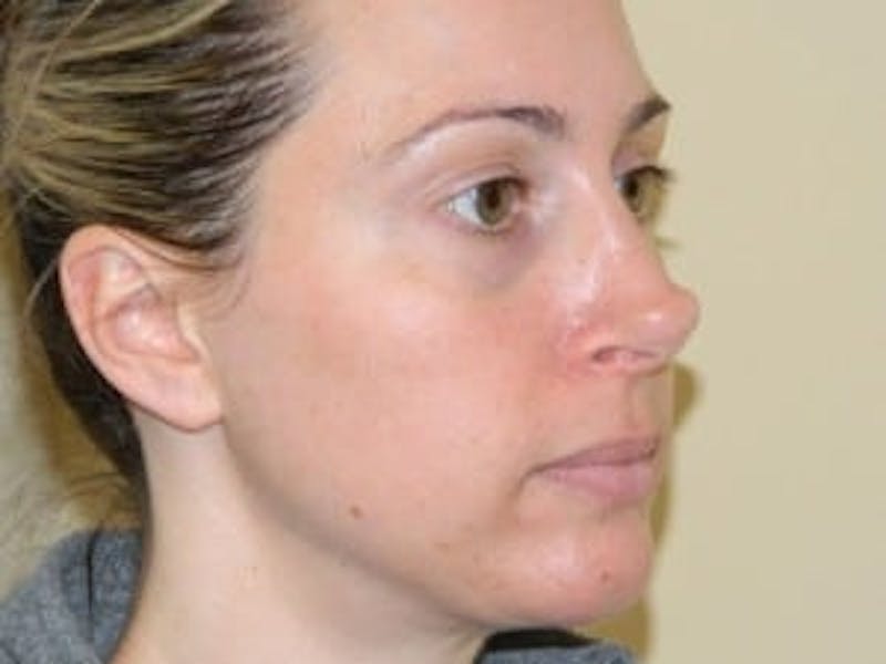 Revision Rhinoplasty Before & After Gallery - Patient 133066545 - Image 5