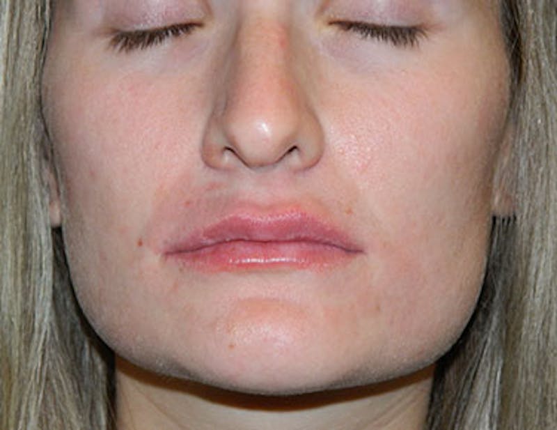 Non-Surgical Rhinoplasty and Injectable Fillers Before & After Gallery - Patient 133066544 - Image 2