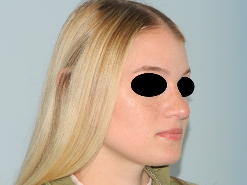 Rhinoplasty Before & After Gallery - Patient 133066549 - Image 4
