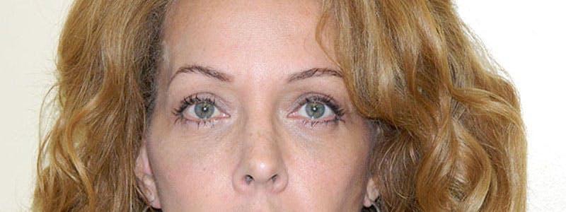 Blepharoplasty (Eyelid Lift) Before & After Gallery - Patient 133066547 - Image 2