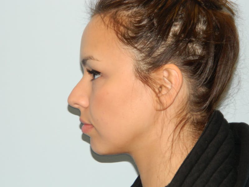 Non-Surgical Rhinoplasty and Injectable Fillers Before & After Gallery - Patient 133066552 - Image 1