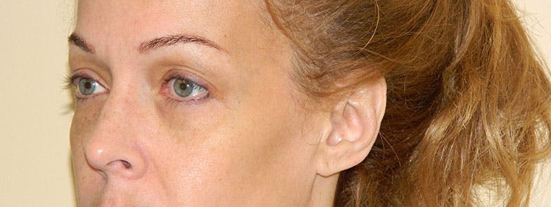 Blepharoplasty (Eyelid Lift) Before & After Gallery - Patient 133066547 - Image 3