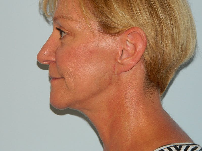 Facelift Before & After Gallery - Patient 133066551 - Image 2