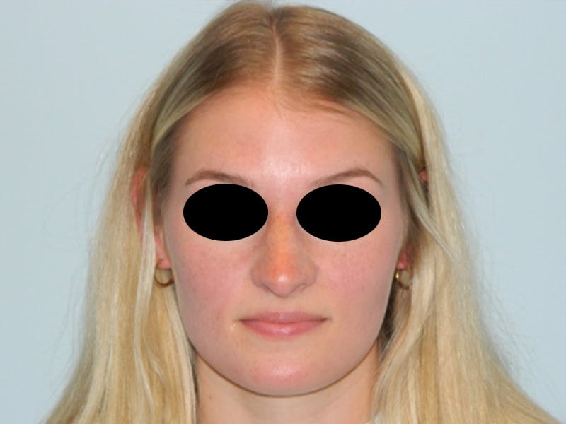 Rhinoplasty Before & After Gallery - Patient 133066549 - Image 5