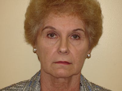 Mini-Facelift Before & After Gallery - Patient 133066553 - Image 1