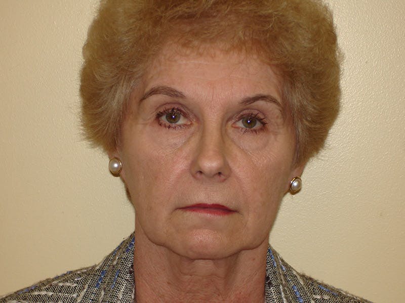 Mini-Facelift Before & After Gallery - Patient 133066553 - Image 1