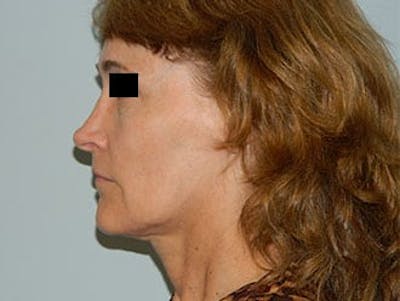 Revision Rhinoplasty Before & After Gallery - Patient 133066548 - Image 1
