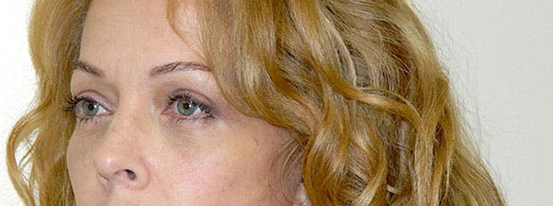 Blepharoplasty (Eyelid Lift) Before & After Gallery - Patient 133066547 - Image 4