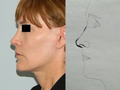 Revision Rhinoplasty Before & After Gallery - Patient 133066548 - Image 2