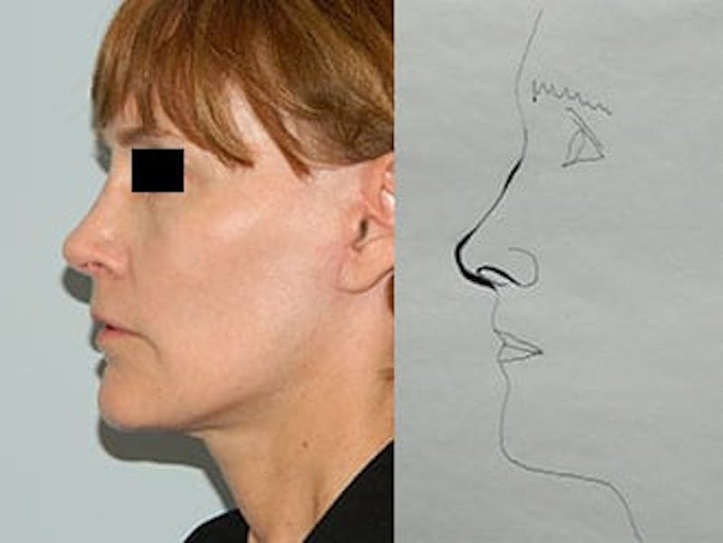Revision Rhinoplasty Before & After Gallery - Patient 133066548 - Image 2