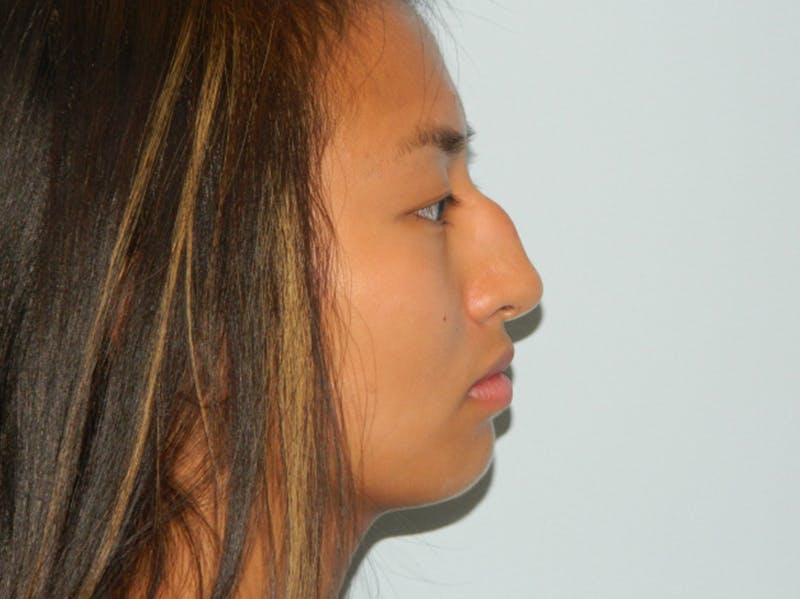 Chin Augmentation Before & After Gallery - Patient 133066555 - Image 3