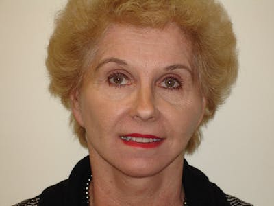 Mini-Facelift Before & After Gallery - Patient 133066553 - Image 2