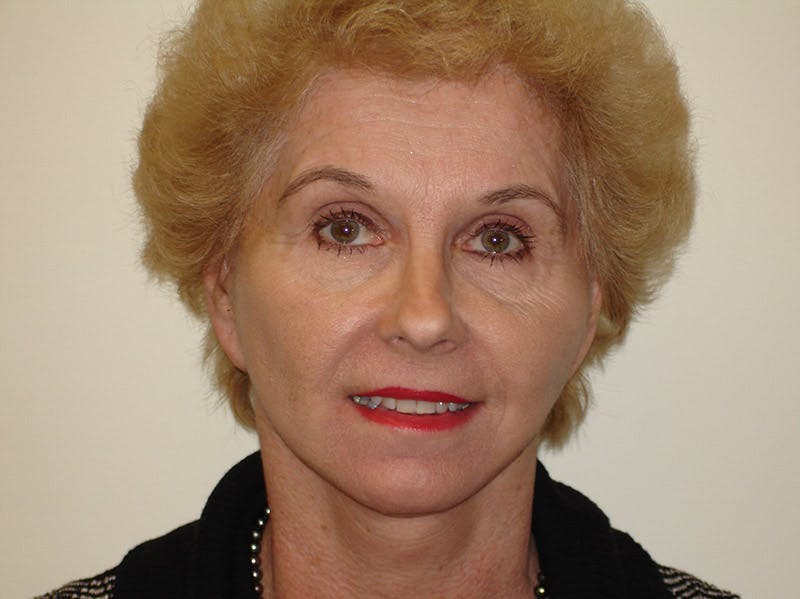 Mini-Facelift Before & After Gallery - Patient 133066553 - Image 2