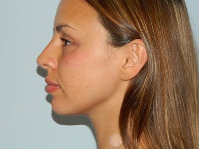 Non-Surgical Rhinoplasty and Injectable Fillers Before & After Gallery - Patient 133066552 - Image 2