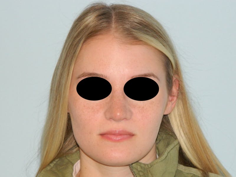 Rhinoplasty Before & After Gallery - Patient 133066549 - Image 6