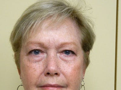 Blepharoplasty (Eyelid Lift) Before & After Gallery - Patient 133066550 - Image 1