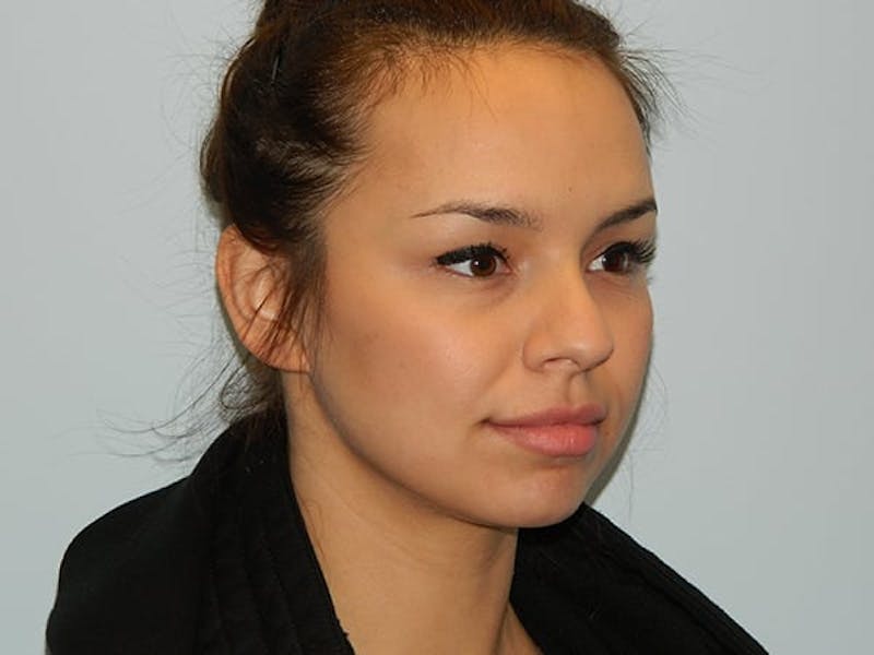 Non-Surgical Rhinoplasty and Injectable Fillers Before & After Gallery - Patient 133066552 - Image 3