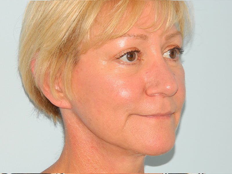 Facelift Before & After Gallery - Patient 133066551 - Image 4