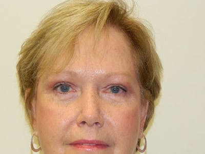 Blepharoplasty (Eyelid Lift) Before & After Gallery - Patient 133066550 - Image 2
