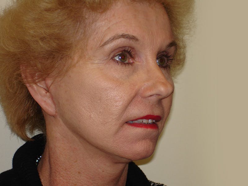 Mini-Facelift Before & After Gallery - Patient 133066553 - Image 4