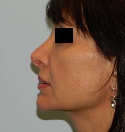 Revision Rhinoplasty Before & After Gallery - Patient 133066556 - Image 1