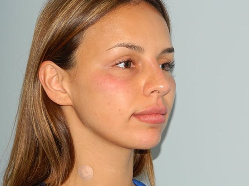 Non-Surgical Rhinoplasty and Injectable Fillers Before & After Gallery - Patient 133066552 - Image 4