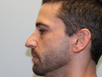 Rhinoplasty Before & After Gallery - Patient 133066561 - Image 1