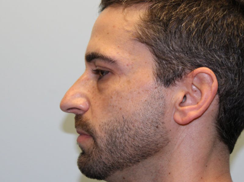 Rhinoplasty Before & After Gallery - Patient 133066561 - Image 1