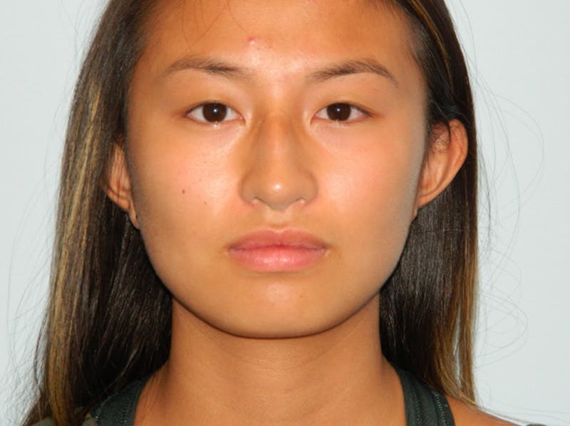 Chin Augmentation Before & After Gallery - Patient 133066555 - Image 5