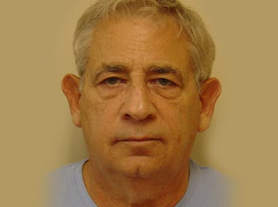 Blepharoplasty (Eyelid Lift) Before & After Gallery - Patient 133066554 - Image 1