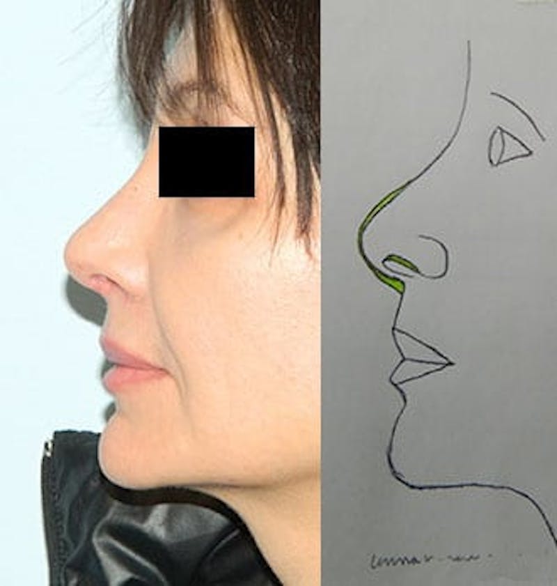 Revision Rhinoplasty Before & After Gallery - Patient 133066556 - Image 2