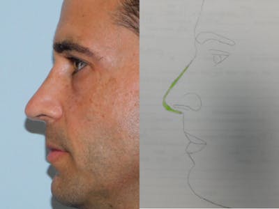 Rhinoplasty Before & After Gallery - Patient 133066561 - Image 2