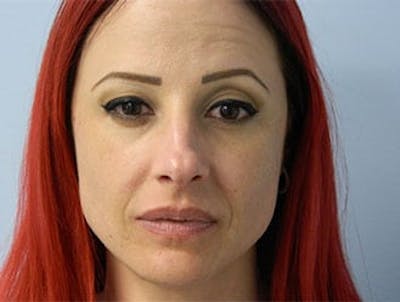 Non-Surgical Rhinoplasty and Injectable Fillers Before & After Gallery - Patient 133066557 - Image 1