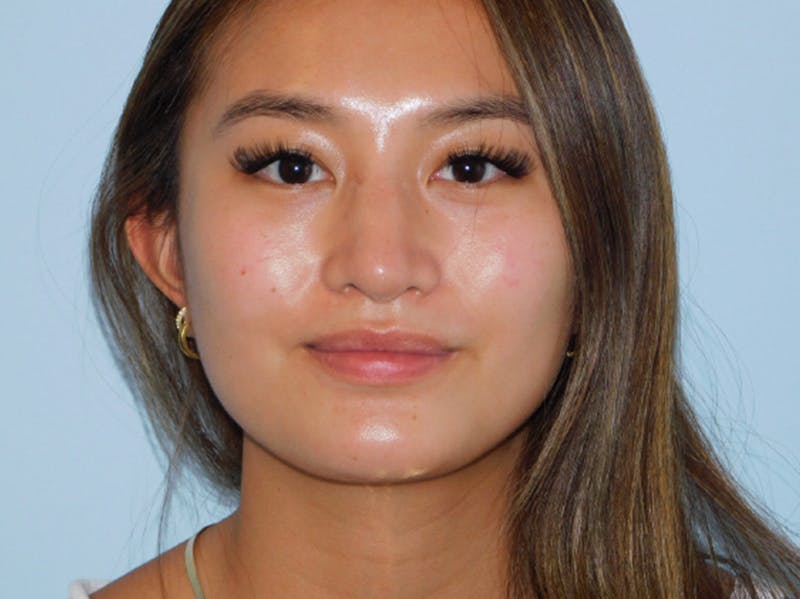 Chin Augmentation Before & After Gallery - Patient 133066555 - Image 6