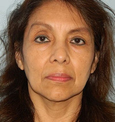 Mini-Facelift Before & After Gallery - Patient 133066558 - Image 1