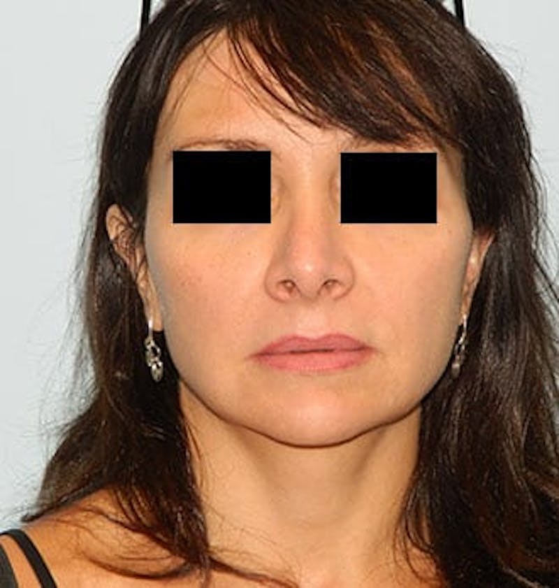 Revision Rhinoplasty Before & After Gallery - Patient 133066556 - Image 3