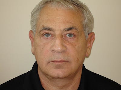 Blepharoplasty (Eyelid Lift) Before & After Gallery - Patient 133066554 - Image 2