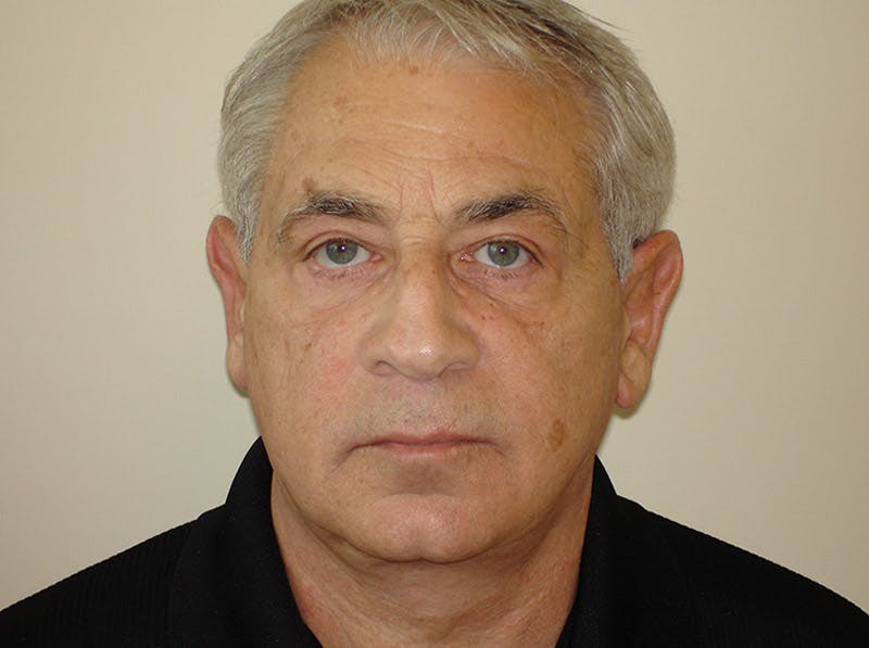 Blepharoplasty (Eyelid Lift) Before & After Gallery - Patient 133066554 - Image 2