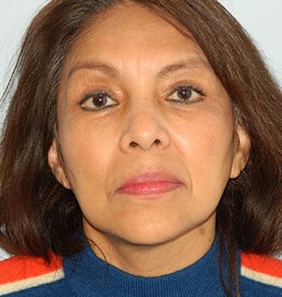 Mini-Facelift Before & After Gallery - Patient 133066558 - Image 2