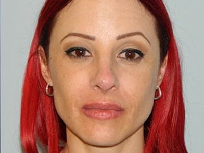 Non-Surgical Rhinoplasty and Injectable Fillers Before & After Gallery - Patient 133066557 - Image 2