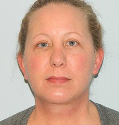Facelift Before & After Gallery - Patient 133066560 - Image 2
