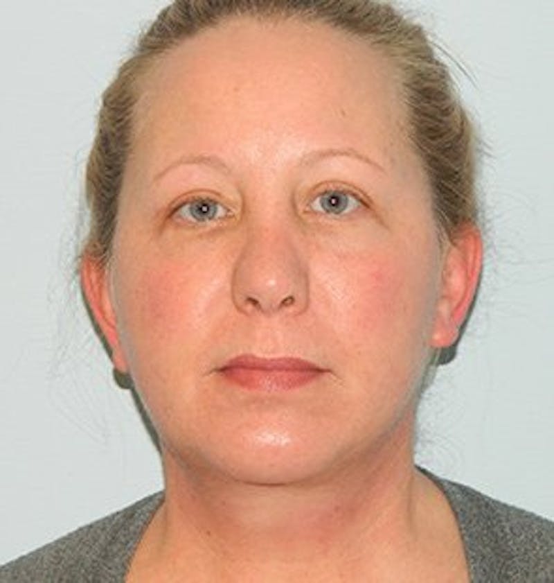 Facelift Before & After Gallery - Patient 133066560 - Image 2