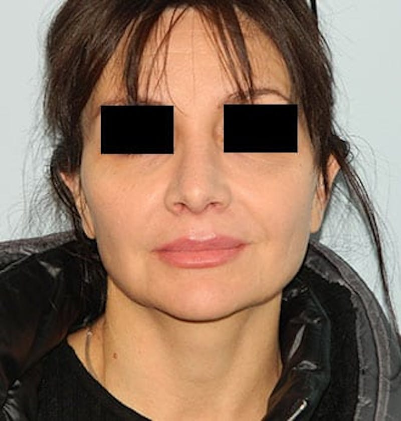Revision Rhinoplasty Before & After Gallery - Patient 133066556 - Image 4