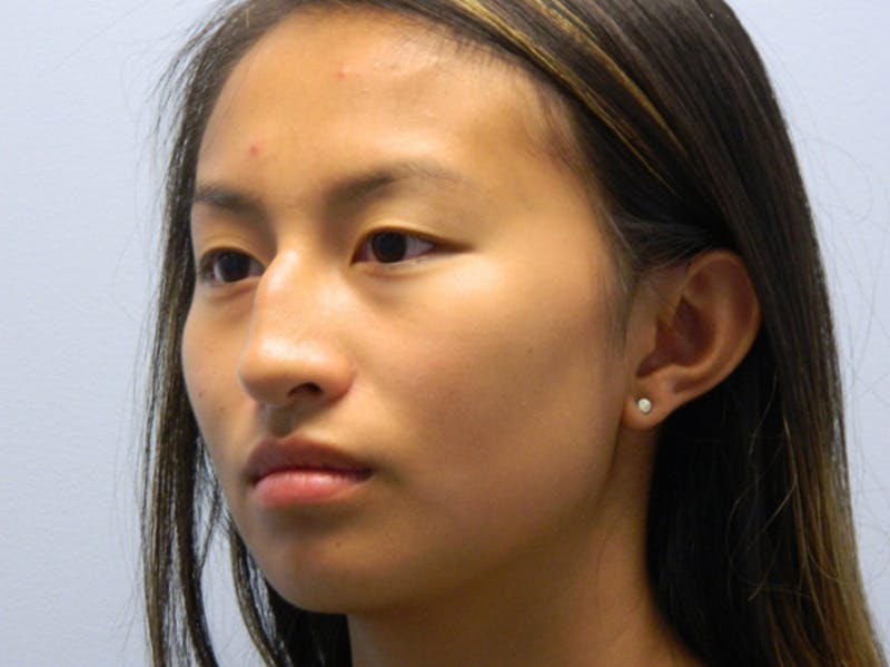 Chin Augmentation Before & After Gallery - Patient 133066555 - Image 7