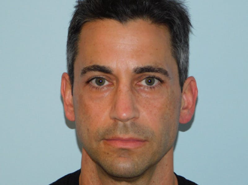 Rhinoplasty Before & After Gallery - Patient 133066561 - Image 4