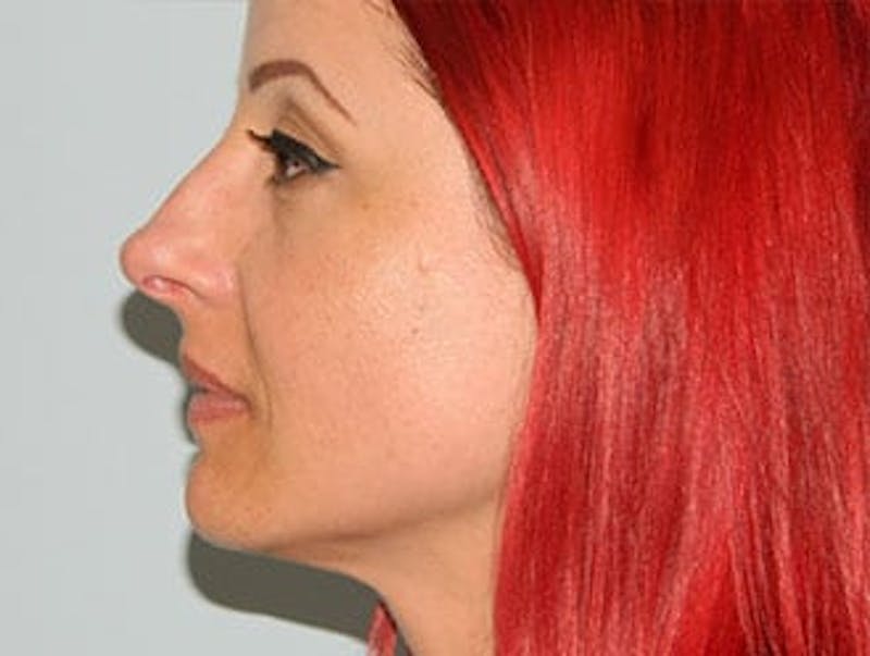 Non-Surgical Rhinoplasty and Injectable Fillers Before & After Gallery - Patient 133066557 - Image 3