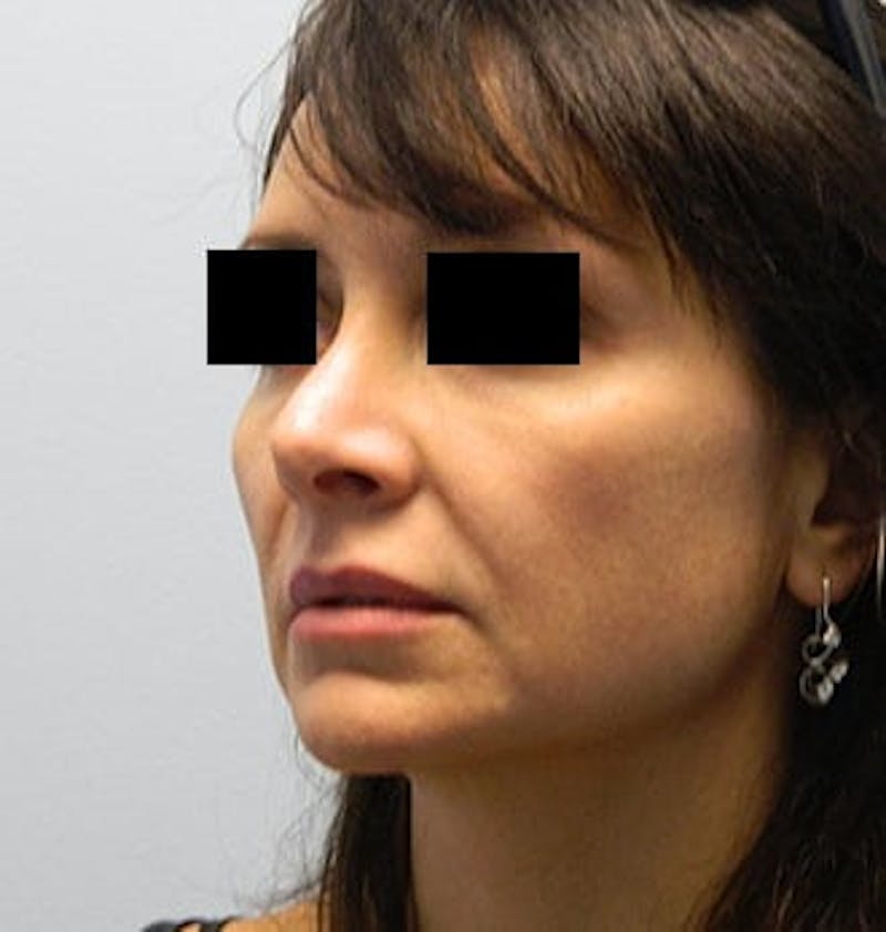 Revision Rhinoplasty Before & After Gallery - Patient 133066556 - Image 5
